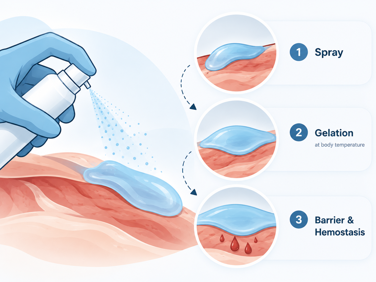 Thermal-sensitive sprayable hydrogel